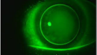 Multifocal GP Contact Lenses Video 3 [upl. by Nemsaj]