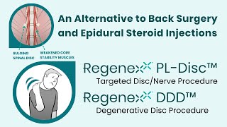 Regenexx PLDisc Avoid the Harmful Side Effects of Epidural Steroids and Back Surgery [upl. by Amsaj765]