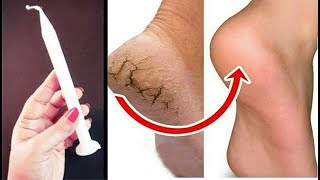 ये तरीका 1 दिन में फटी एड़ियां से छुटकारा पाये Cracked Heels Home Remedy  Crack Heels Treatment [upl. by Rayham722]