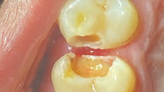 RESTORATION OF GROSSLY CAVITATED UPPER TEETH [upl. by Oicanata]