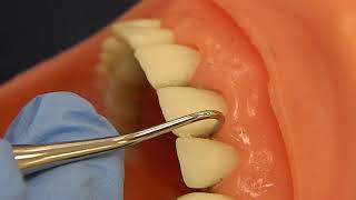 How to Use Sickle Scalers [upl. by Mastrianni]