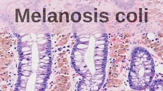 What is Melanosis Coli  Pathology mini tutorial [upl. by Harcourt]