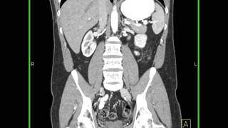 Abdomen Small BowelCrohns 3D mapping shows thickening of the ileum with increased vascularity [upl. by Wallis]