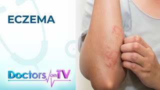 Eczema Symptoms Causes and Treatment  Doctors on TV [upl. by Joyce]