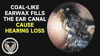 COALLIKE CERUMEN FILLS The Ear Canal Causes Hearing Loss [upl. by Kaufman]