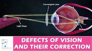 DEFECTS OF VISION AND THEIR CORRECTION [upl. by Aelanna50]