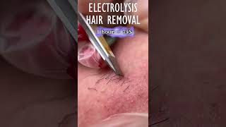 Electrolysis Hair Removal [upl. by Neik]