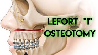 LEFORT 1  OSTEOTOMY  ORTHOGNATHIC SURGERY [upl. by Nanaj]