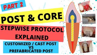 POST AND CORE Part2  SIMPLE STEPS FOR POST amp CORE PROCEDURE  Customized VS Prefabricated Post [upl. by Carlin]