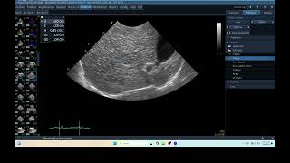 IQ 276 LIVER HEPATOMA PDH ULTRASOUND ECHOPAC ANALYSIS [upl. by Hamann]