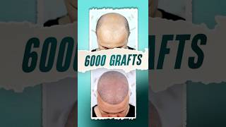 Hair Transplant from Russia to Bangladesh hairtransplant russia bangladesh shorts [upl. by Pickens]