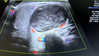 Ultrasound of pathologically confirmed case of pleomorphic adenoma of parotid gland [upl. by Hazel455]