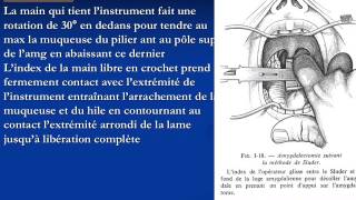 ORL AMYGDALECTOMIE [upl. by Bowles]