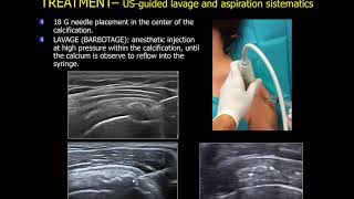 echoguided lavage of the calcific tendinitis of the shoulder [upl. by Letnuahc]