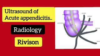 Ultrasound of Acute appendicitis  Radiology [upl. by Mcgrath307]