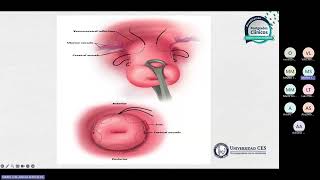 El Cerclaje cervical de emergencia salva vidas [upl. by Tremain545]