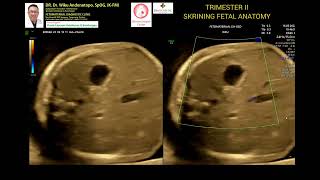 Trimester II Fetal anomaly screening [upl. by Aeht]