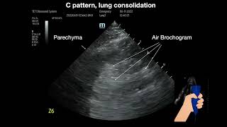 Lung consolidation [upl. by Krebs]