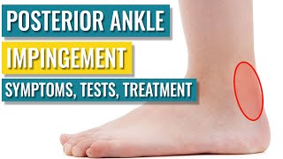 Posterior Ankle Impingement  Symptoms Diagnosis Treatment amp Recovery Time [upl. by Anirad]