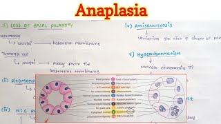 Anaplasia  Neoplasia  General Pathology [upl. by Dlnaod652]