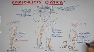 Radiculitis Ciática L4 L5 S1  Hernia de disco lumbar [upl. by Aracot]