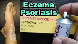 Eczema Psoriasis  Betnovate C Skin Cream [upl. by Eceinert]