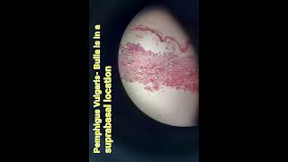 Pemphigus vulgarisdermapathskinbullous diseaseHand Ehistologypathologymedical [upl. by Diandre]