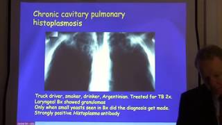 Diagnosis and treatment of chronic pulmonary aspergillosis [upl. by Naujd]