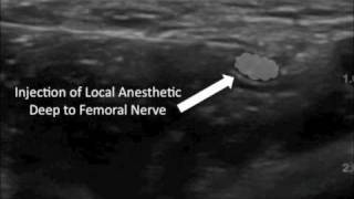 Ultrasound Guided Femoral Nerve Block [upl. by Gewirtz329]