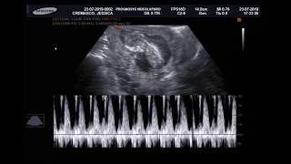 Ultrassonografia Obstétrica com medida da Translucência Nucal  12 semanas e 6 dias [upl. by Airotnahs]