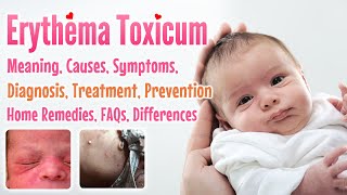 Erythema toxicum overview causes sign and symptoms treatment prevention home remedies FAQs [upl. by Haela]