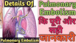 Pulmonary Embolism  Pulmonary Embolism कि पूरी और सही जानकारी और ईलाज। हिंदी में। [upl. by Uticas]