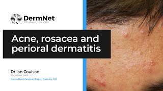 Acne Rosacea and Perioral Dermatitis [upl. by Yknarf761]