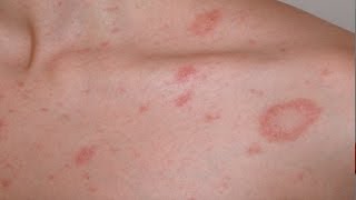 Pityriasis rosea English version [upl. by Pinzler]