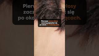 Jak długo trwa gojenie po przeszczepie włosów hairtransplant bhrclinic [upl. by Noyart]