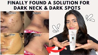 Dark neck amp Hyperpigmentation treatment  Acanthosis Nigricans treatment [upl. by Kessler302]