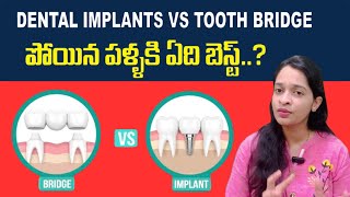 Dental Implants Vs Tooth Bridge in Telugu  Best option to replace missing teeth [upl. by Deedee545]