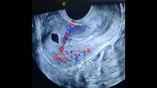 Ultrasound of Ashermans Syndrome [upl. by Moses770]