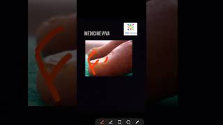 Medicine Koilonychia spoon nail iron deficiency anemia [upl. by Jayme]