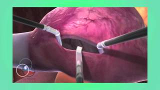 Atrial Septal Defect Repair at SSM Heart Institute [upl. by Alleusnoc]