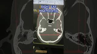 HRCT Temporal Bone Pathology Right Ear Mastoiditis [upl. by Baram255]