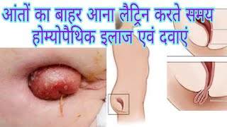 prolapse of rectum homoeopathic treatment [upl. by Orferd]