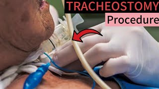 Tracheostomy Procedure 3D Animation 🥺 [upl. by Perl]