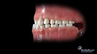 Anterior Crossbite Skeletal or Functional [upl. by Waylon]