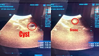 Left Renal Stone Nephrolithiasis with Left Renal Cyst ScanningDiagnosis in Ultrasonography [upl. by River158]