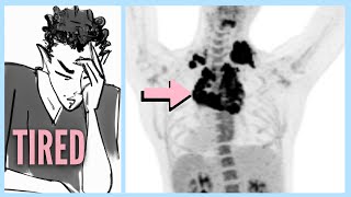 LYMPHOMA After Ignoring 6 WARNING Signs [upl. by Nova570]