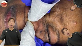 The MOST TERRIFYING Acne Squeezing Videos Youve Ever Seen 6 [upl. by Kristo]