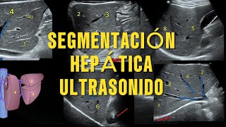 Segmentación Hepática de Couinaud por Ultrasonido La Guía Esencial para Radiología [upl. by Odragde144]