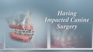 Having Impacted Canine Surgery [upl. by Ettelrats]