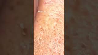 Pickel Ausdrücken Spa  Blackheads Akne amp Mitesser entfernen 🔴 30 [upl. by Laise]